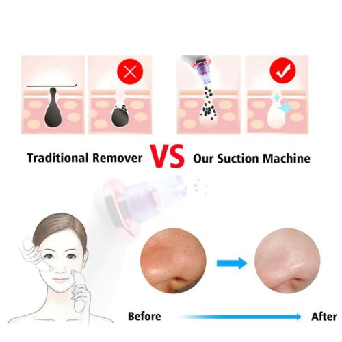 Blackhead Remover Vacuum Suction Pore Cleaner Facial Acne Cleaning Tool