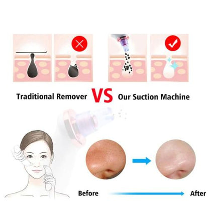 Blackhead Remover Vacuum Suction Pore Cleaner Facial Acne Cleaning Tool