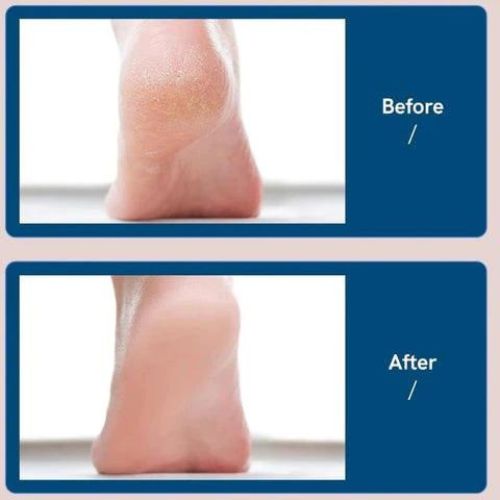 Electric Foot File Callus Remover Pedicure Dead Skin Removal Device