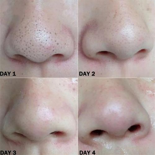 Nose Blackhead Remover Strips Deep Pore Cleansing Oil Control Nose Strips